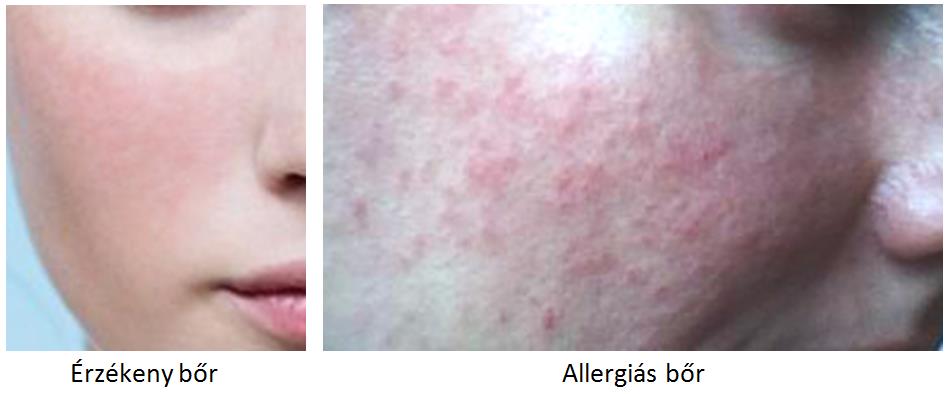 érzékeny és allergiás bőr